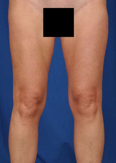 Thigh Liposuction Denver, Colorado | ABS Institute