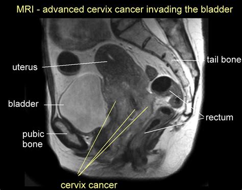 can bladder cancer be seen on ct scan Updated