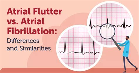 Atrial Flutter vs. Atrial Fibrillation: Differences and Similarities | MyHeartDiseaseTeam