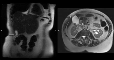 Cholesterolosis Of Gallbladder Mri - A Pictures Of Hole 2018