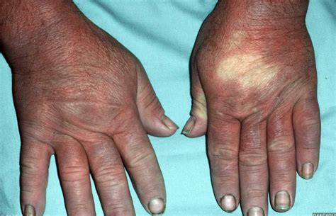 Raynaud's Disease - Causes, Symptoms, Treatment