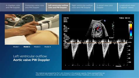 Advanced screening views of the fetal heart - Part 3 - Left ventricular outflow color and PW ...