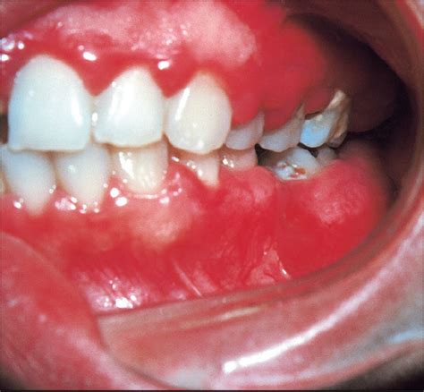 Erythematous Oral Lesions: When to Treat, When to Leave Alone | Consultant360