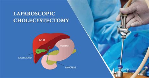 Laparoscopic Cholecystectomy | Laparoscopic surgery, Gallbladder, Nuclear medicine