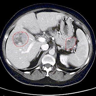 CT scan showing a marked reduction in size of the liver lesion after 5 ...