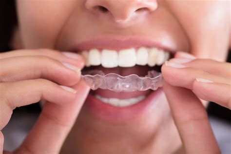 Bruxism - Treatment with mouth guards and splints - Dentist Belgrade