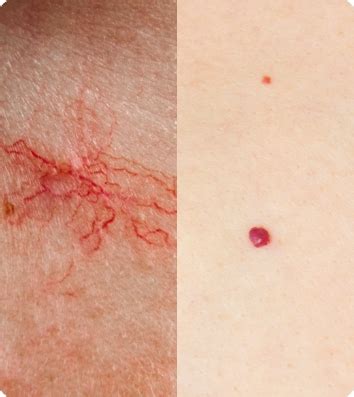 Cherry & Spider Angioma Removal | Markham’s Premier Clinic