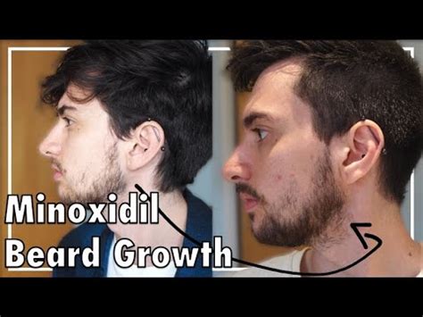 Minoxidil Before And After Beard Result - Minoxidil Before And After ...