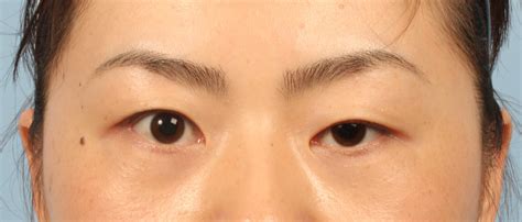 Wong Chin Ho - W Aesthetics Plastic Surgery - Corrective Eyelid Surgery – PTOSIS, ECTROPION