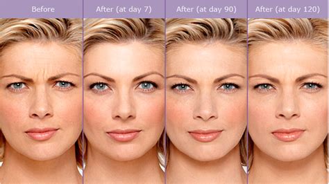 Botox NYC | Fillers NYC | Juvederm Restylane NYC — Lara Devgan, MD, MPH, FACS