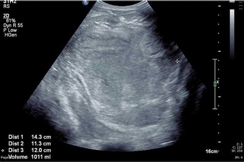 Space Of Retzius Ultrasound