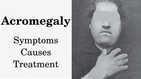 What is Acromegaly and How to Deal With It | Best HGH Doctors and Clinics