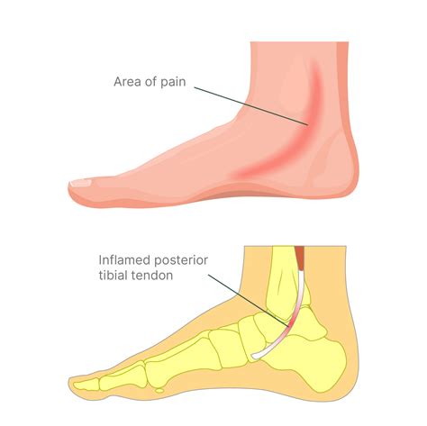 Tibialis Posterior Tendinopathy | Diagnosis, Causes & Treatments