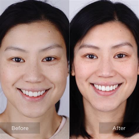 Invisalign Before and After - The Dental Room