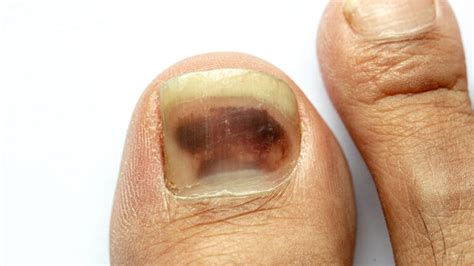 fingernail melanoma images | Symptoms and pictures