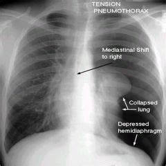 ghon complex radiology - Google Search | Radiology, Medicine, Medical