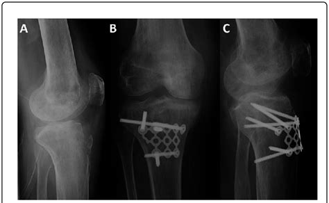 Radiograph of a tibial tuberosity fracture in a fifty year old male ...