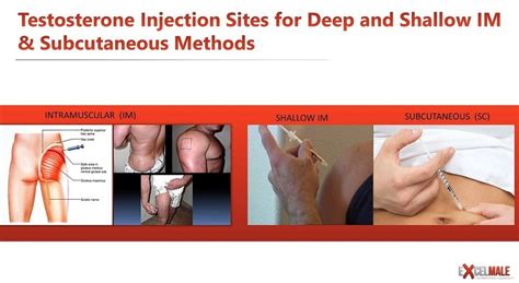 Where to Inject Testosterone: Intramuscular vs. Subcutaneous Injections