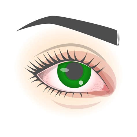 What is Corneal Abrasion? Treatment & Healing Timeline