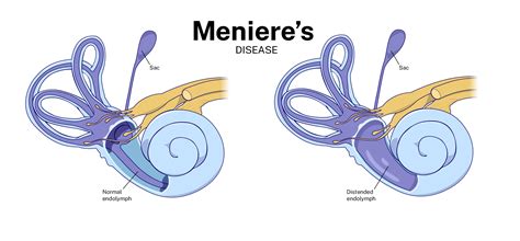 Meniere's Disease/Endolymphatic Hydrops Ear Institute Of Texas, And Voice Swallowing Institute ...