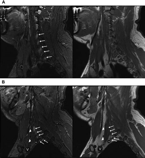 Mri Brachial Plexus Axial T Images | The Best Porn Website