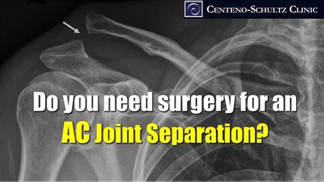 Acromioclavicular Joint Separation Treatment