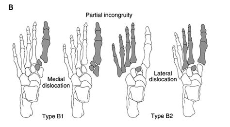 Lisfranc Injury - Foot & Ankle - Orthobullets