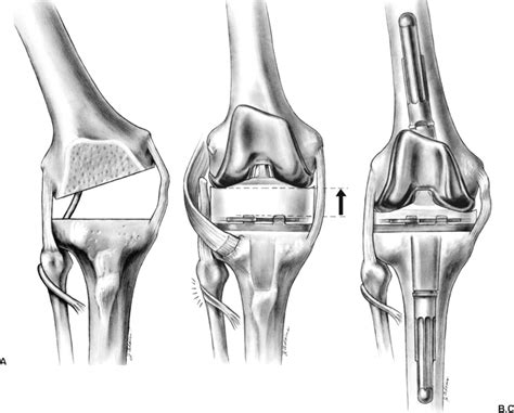 Total Knee Replacement: Valgus Release | Musculoskeletal Key