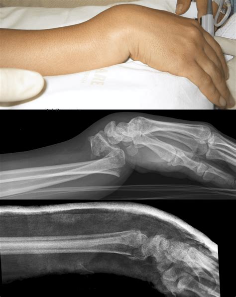 Moore fracture • LITFL Medical Blog • Medical Eponym Library