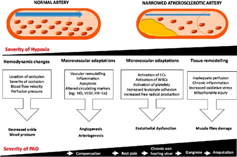 Acute Limb Ischemia Pathophysiology