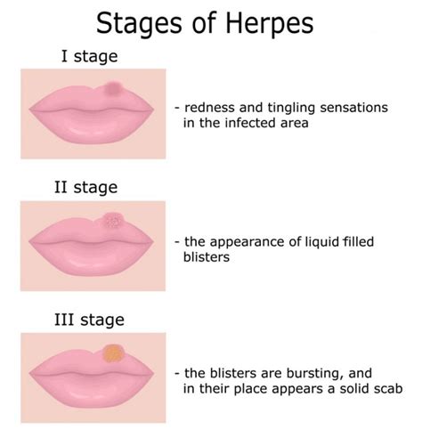 Oral Herpes: Symptoms, Causes, & Treatments