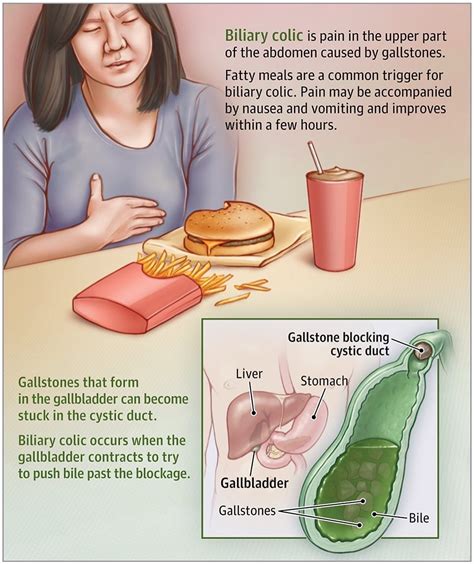 Biliary colic is the pain caused by gallstones. The gallbladder is a pouch the size of a lime ...