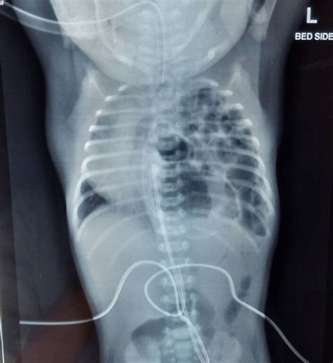 Congenital diaphragmatic hernia in siblings | Pediatric Oncall Journal