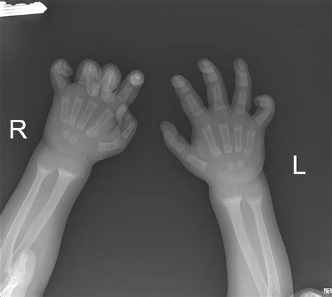 Rickets: active | Radiology Case | Radiopaedia.org Pediatric Radiology, Dr Ian, Radiology ...