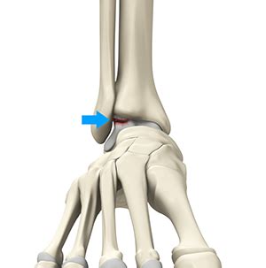 OCD Ankle Surgery New York | Osteochondritis Dissecans | Dr John Kennedy