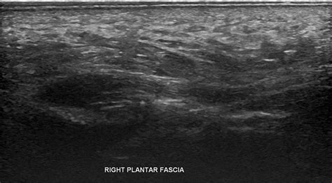 Plantar Fasciitis - Diagnostic Imaging - Melbourne Radiology