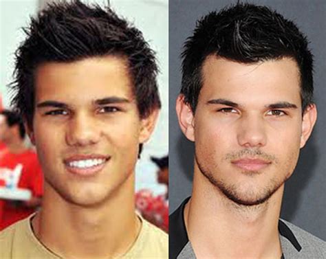 Taylor Lautner Nose Job Plastic Surgery Before and After | Celebie