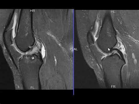 mucoid degeneration of acl treatment - speranzalindy