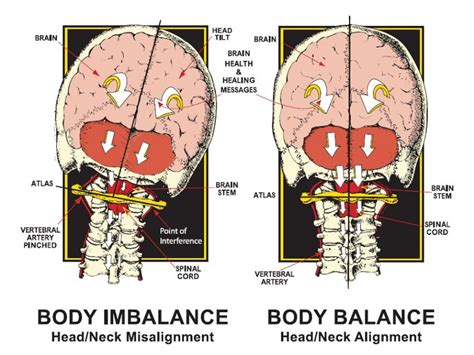 Treating Neurologic-like Symptoms By Addressing Cervical, 52% OFF