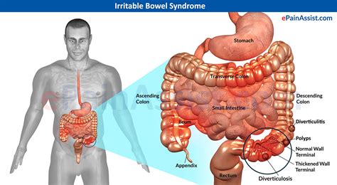 8 Puntos eficaz de acupresión para Síndrome del Intestino Irritable Tratamiento