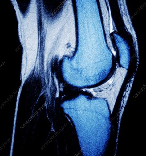 Healthy knee, MRI scan - Stock Image - P116/0509 - Science Photo Library