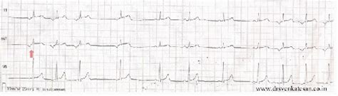 wandering pacemaker | Dr.S.Venkatesan MD