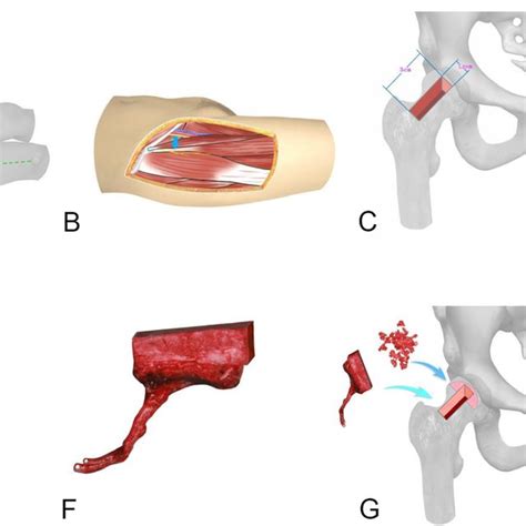 (PDF) Free vascularized iliac bone flap based on deep circumflex iliac ...