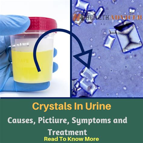 Crystals In Urine: Causes, Picture, Symptoms and Treatment