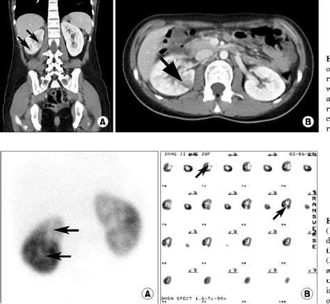 Figure 1 from Diagnosing Acute Pyelonephritis with CT, 99mTc-DMSA SPECT, and Doppler Ultrasound ...