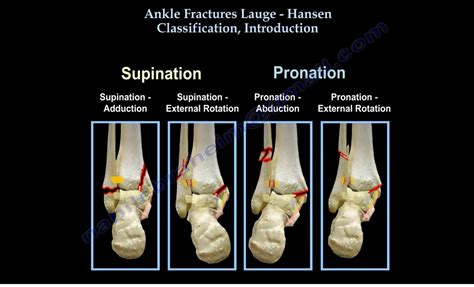 Lauge Hansen Classification of Ankle Fractures — OrthopaedicPrinciples.com