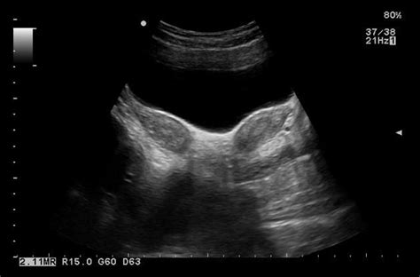 Bicornuate uterus - Mullerian duct anomaly | Bicornuate uterus, Uterus, Sonography