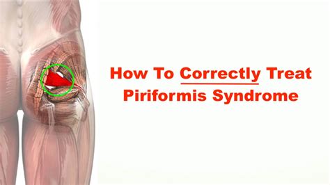 How to Correctly Treat Piriformis Syndrome – Squat University