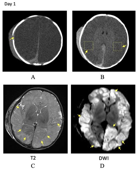 Cureus | Big Black Brain Phenomenon: Understanding Clinicoradiological ...