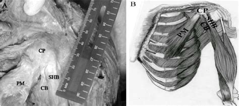 A: The figure is showing the muscular attachment of coracoid process.... | Download Scientific ...